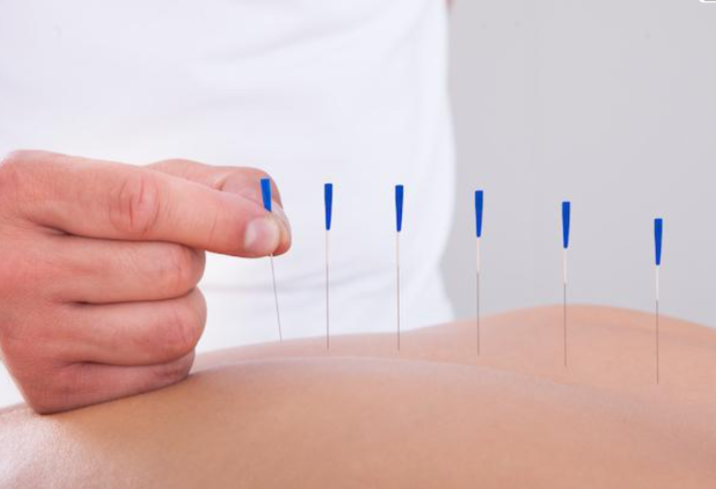https://primehealthcare.ca/wp-content/uploads/2023/01/ACU-Needle-therapy-1024x700.png